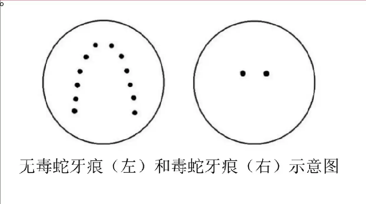 专家：毒蛇咬伤牙痕通常为2个，被咬后尽可能记清蛇特征或拍照