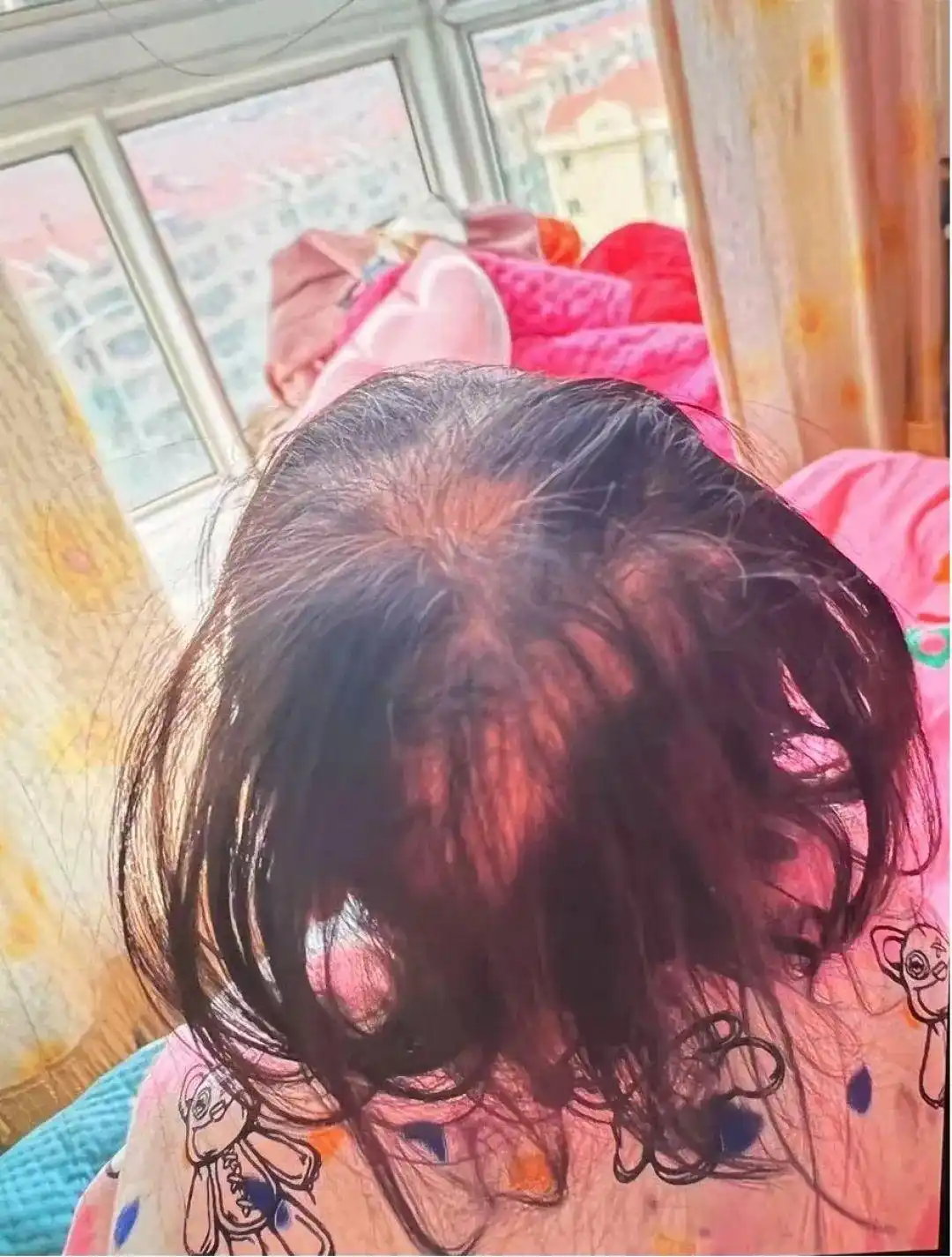 比砒霜还毒！湖南一3岁女童查出急性铊中毒，眼神呆滞、大把脱发、走路如踩棉花……